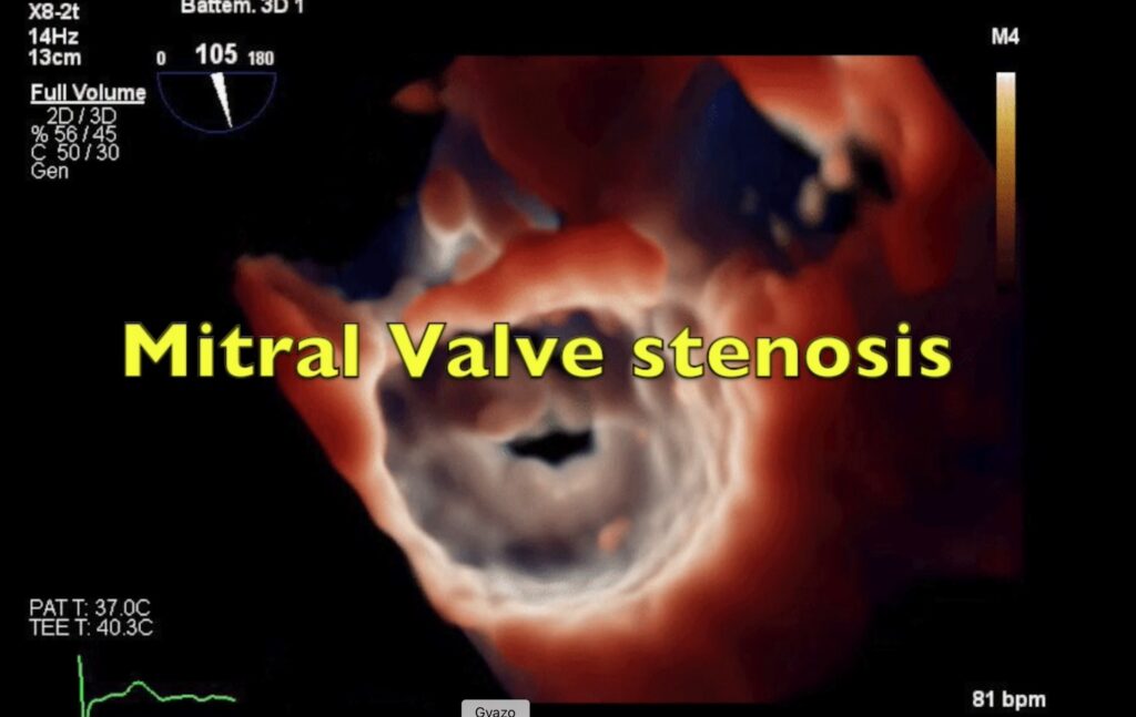 Echocardiography Archives - Page 5 sur 21 - Echovision